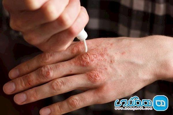 چرا پسوریازیس با بیماری های مفصلی مرتبط است؟